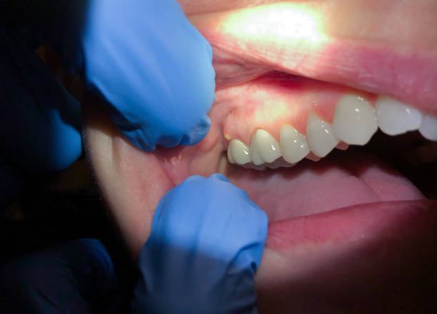 Best Emergency Wisdom Teeth Removal in St Croix Falls, WI